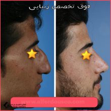 تجميل الأنف | الدكتور ابراهيم حاتمي بور