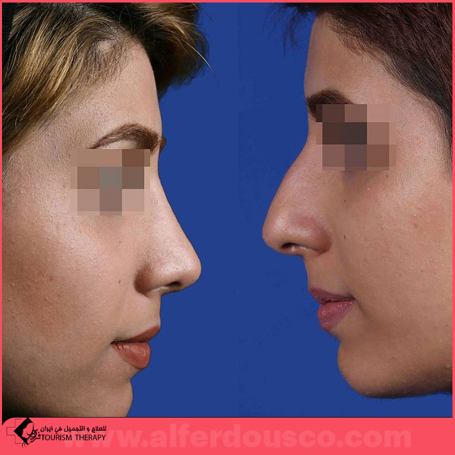 تجميل الأنف | الدكتور ابراهيم حاتمي بور