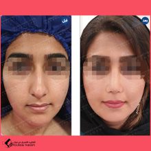 تجميل الأنف | الدكتور محمد مهدي ده بزرگي