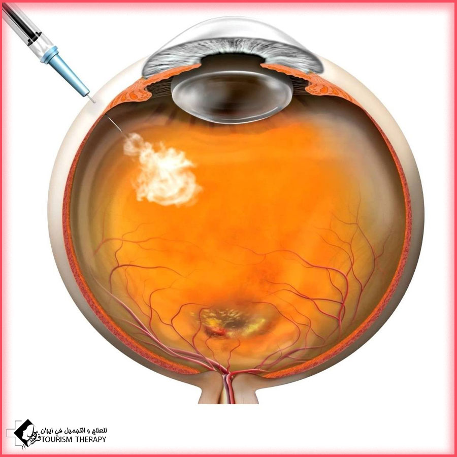 eylea injection shiraz حقنة ايليا