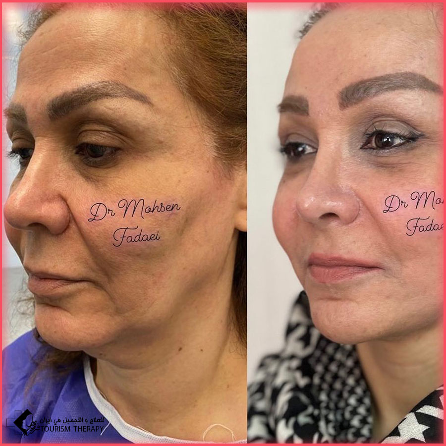 face and neck lift dr fadaei Iran شد الوجه والرقبة