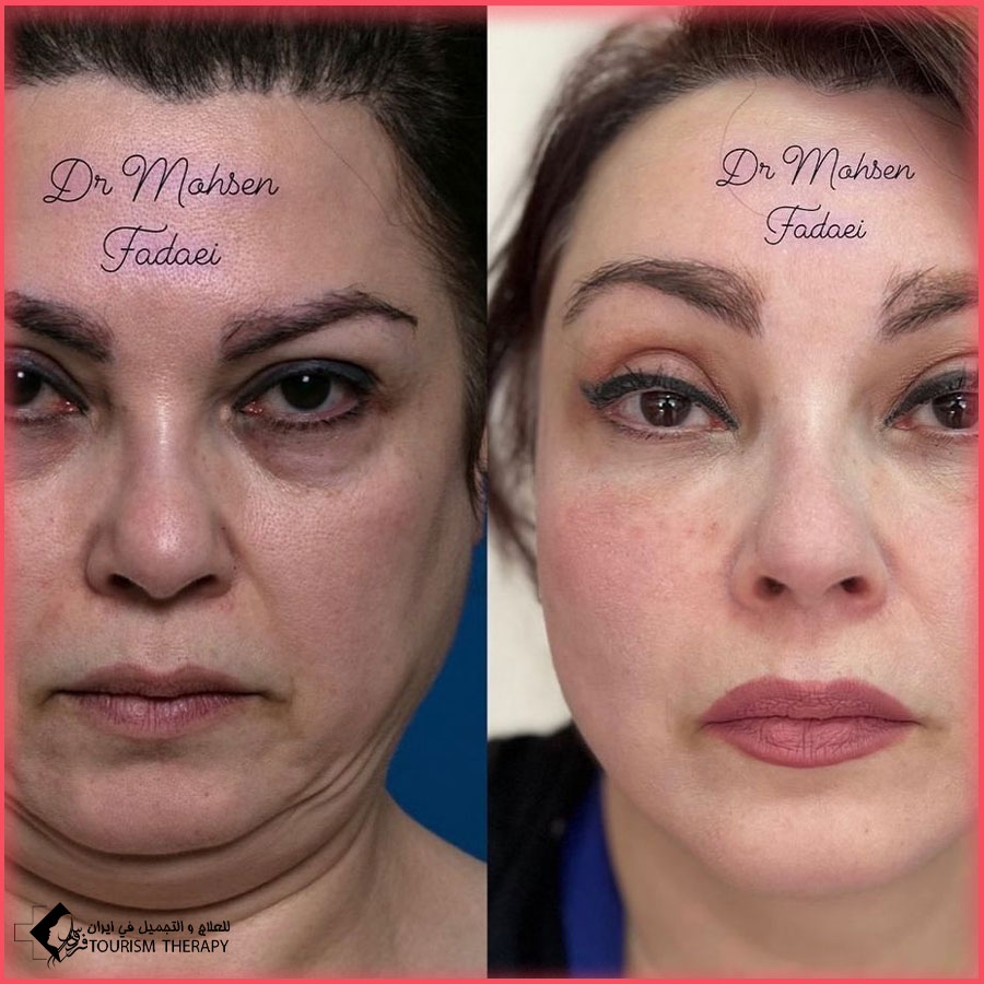 face and neck lift dr fadaei in Tehran شد الوجه والرقبة