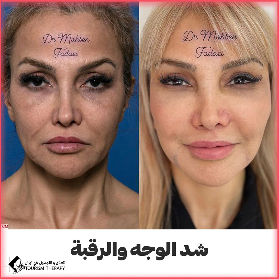 face and neck lift dr fadaei شد الوجه والرقبة