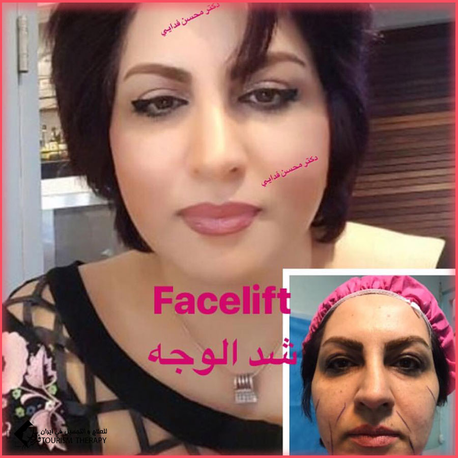 face and neck lift surgery dr fadaei شد الوجه والرقبة