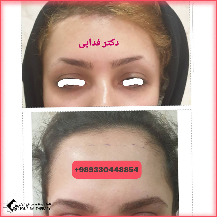 تصغير الجبهة
