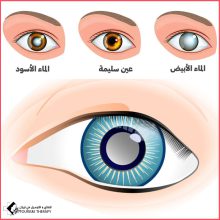 جراحة واحدة لحل مشكلتي العين: الماء الأبيض والجلوكوما في مستشفى خدادوست شيراز – استعادة الرؤية والتخلص من ارتفاع ضغط العين بأحدث التقنيات