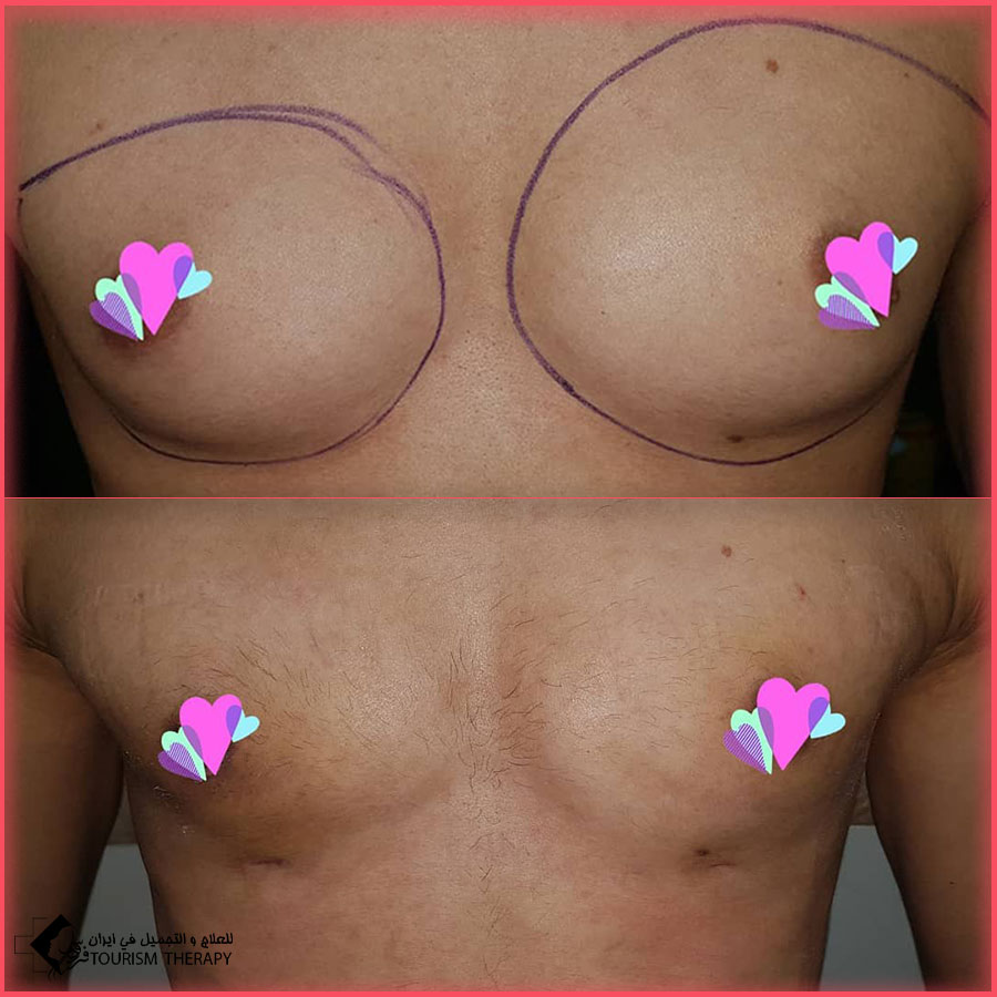 Gynecomastia Surgery in Tehran Dr.Hadi .Amali قبل وبعد عملية تثدي الرجال في طهران