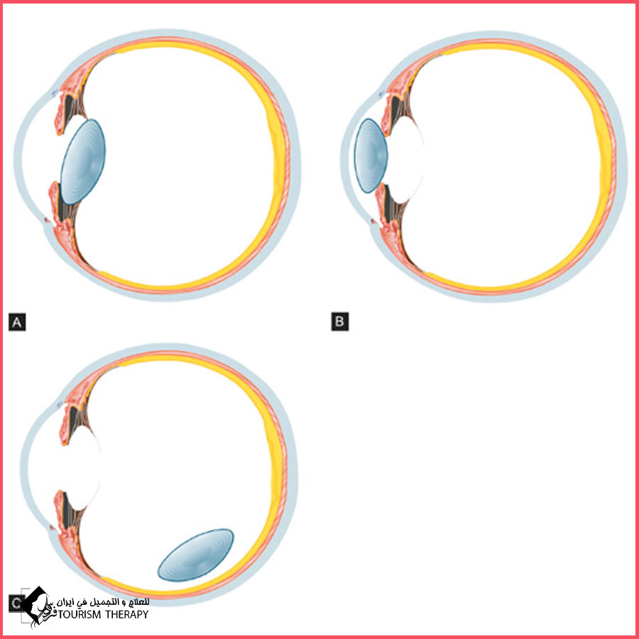 iol dislocation shiraz خلع العدسة Intraocular Lens Dislocation