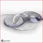 خلع العدسة Intraocular Lens Dislocation