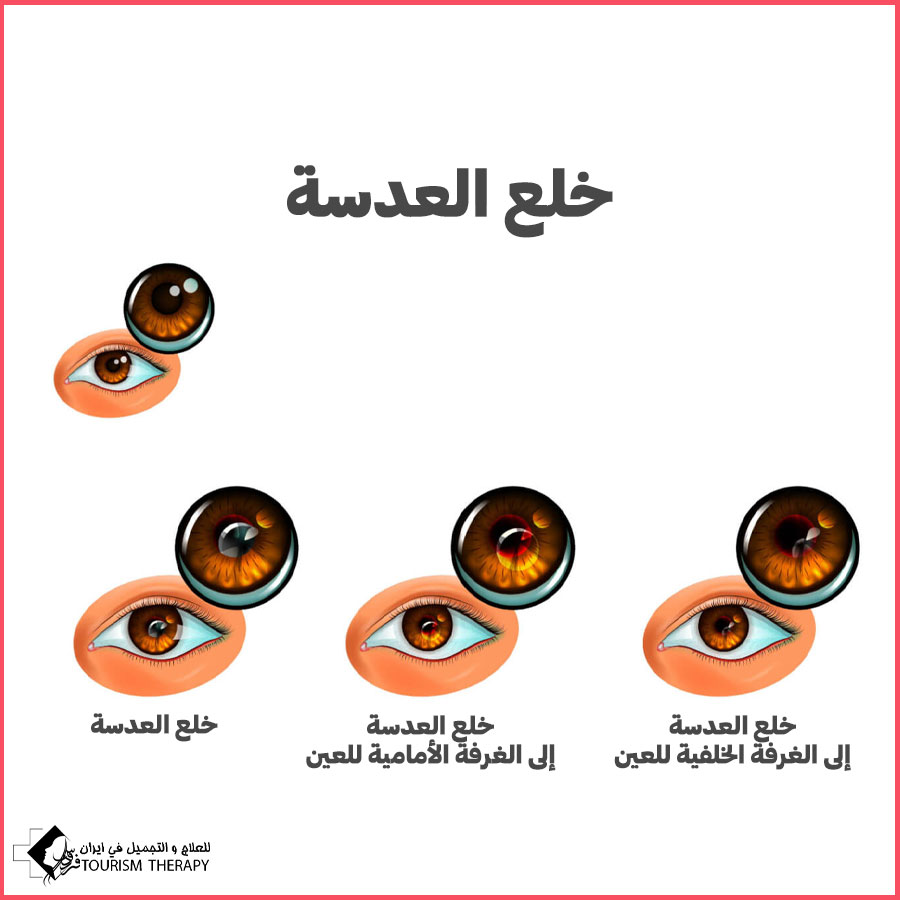 iol dislocation syz surgery خلع العدسة Intraocular Lens Dislocation