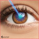 ليزر PI الماء الأسود تحت التخدير