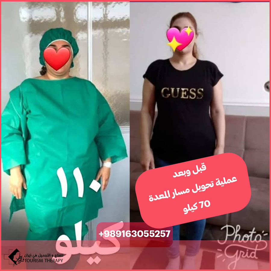 تحويل مسار المعدة المصغر في شيراز | الدكتور سيد ناصر افشين