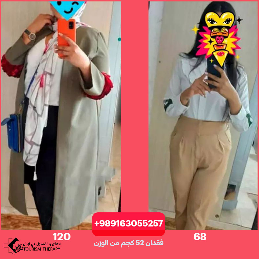 تحويل مسار المعدة المصغر في شيراز | الدكتور بابك حسيني
