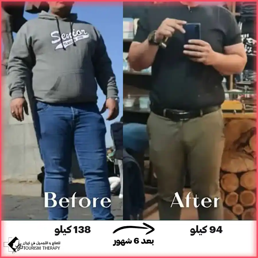 عملية تحويل مسار المعدة المصغر في مشهد مع الدكتور محمد ابراهيم كلانتري