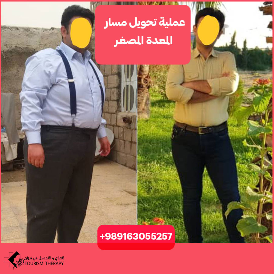 تحويل مسار المعدة المصغر في شيراز | الدكتور سيد محمد حسن هاشمي