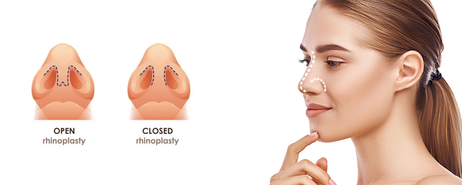 تجميل الأنف المفتوحة 4 تجميل الأنف المفتوحة