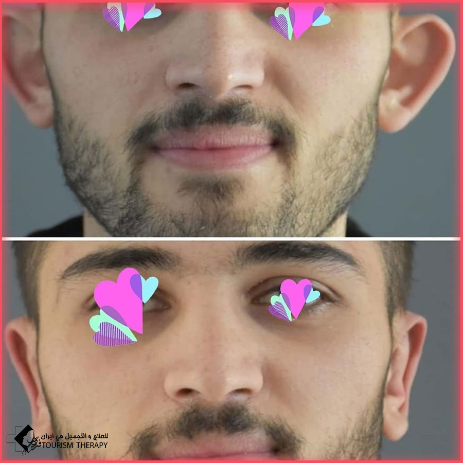 Otoplasty in Tehran Dr.Amali BeforeAndAfter جراحة تجميل الأذن البارزة
