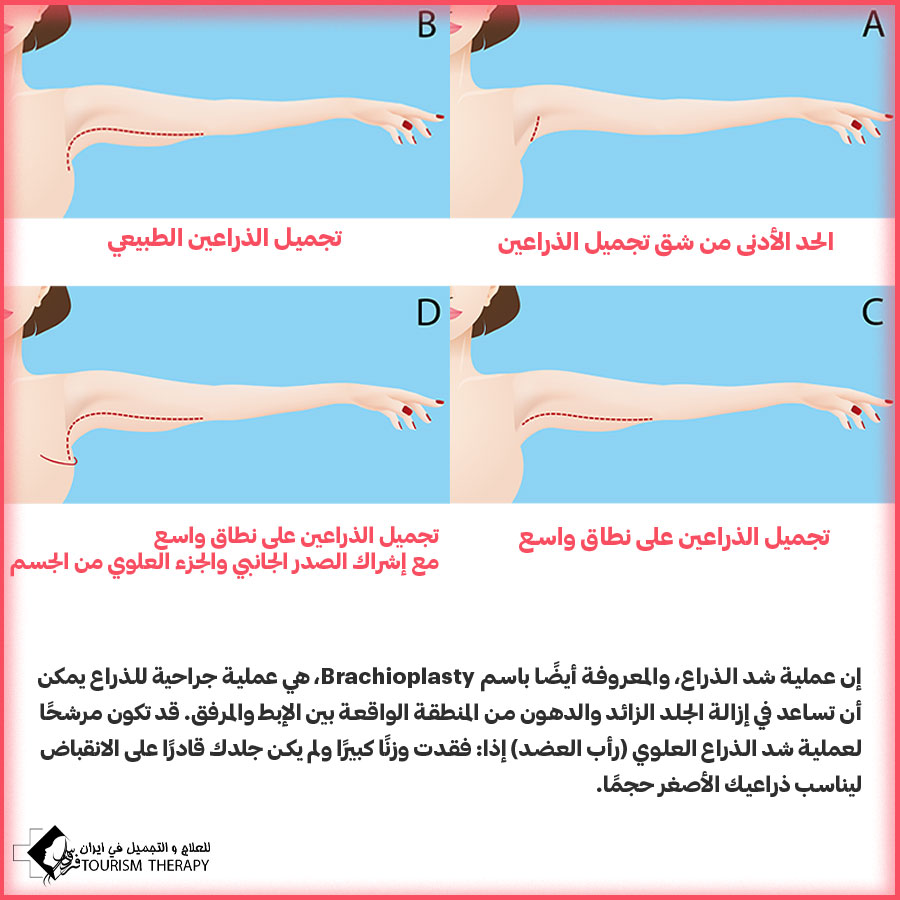 pes of Arm Lift Procedures Iran شفط وشد الذراعين