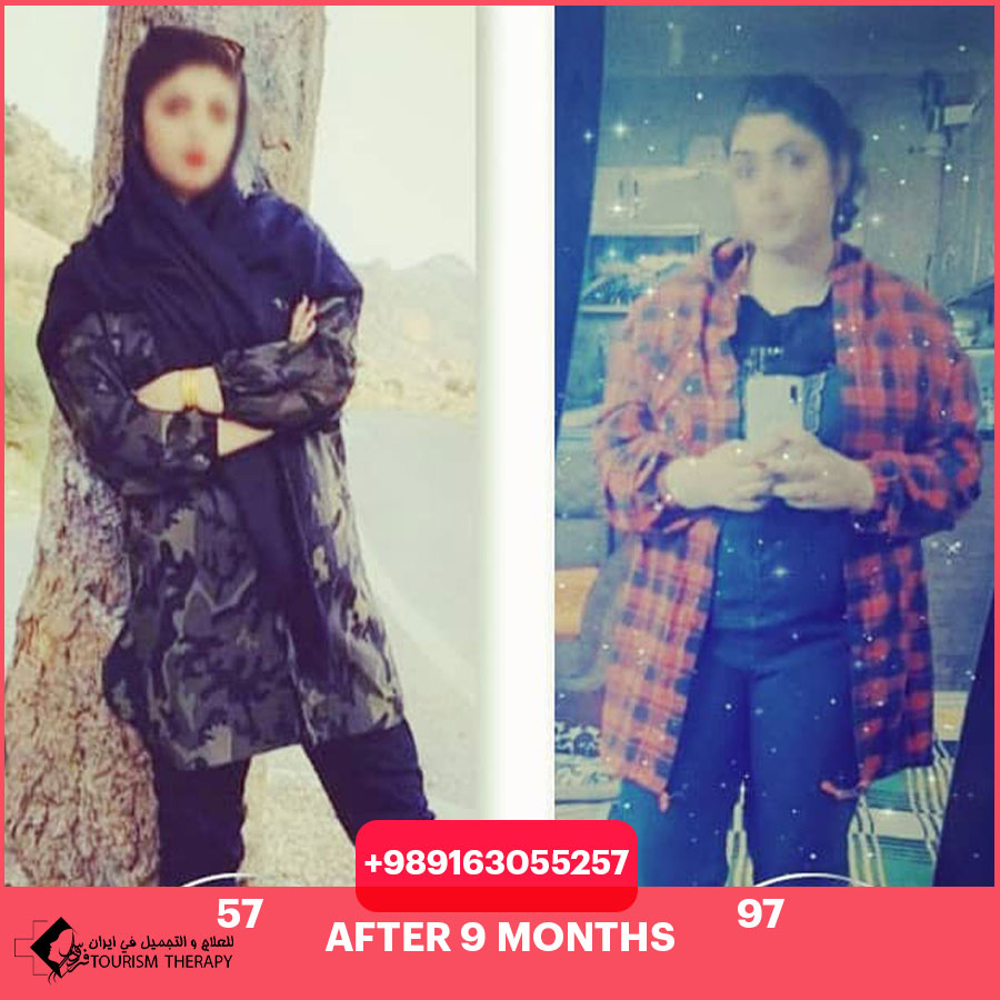 عملية طي المعدة في شيراز مع الدكتور بابك حسيني