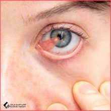 عملية إزالة ظفرة العين (لحمية العين) في مستشفى خدادوست شيراز – العلاج والأسباب والجراحة بالليزر