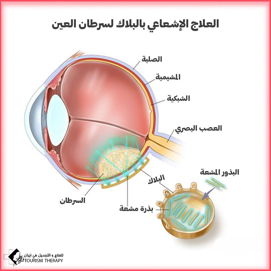 العلاج الإشعاعي بالبلاك لسرطان العين