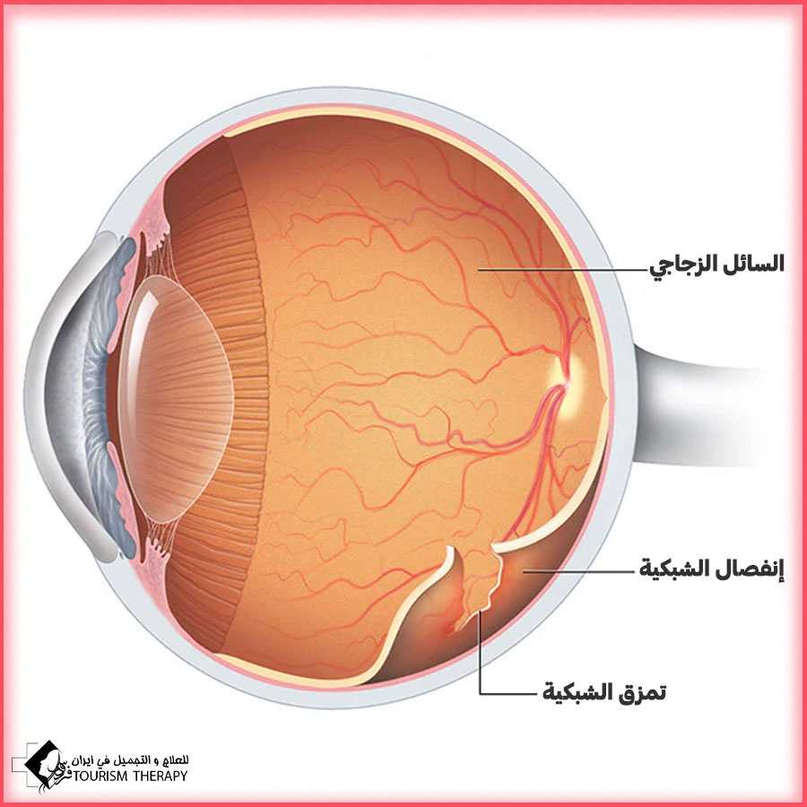 retinal detachment vitrectomy shiraz قص السائل الزجاجي