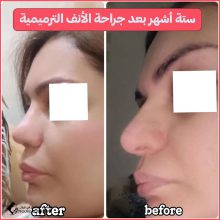 ترميم الأنف | الدكتور حسين كرم نجاد