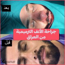 ترميم الأنف | الدكتورة زهراء خسروي