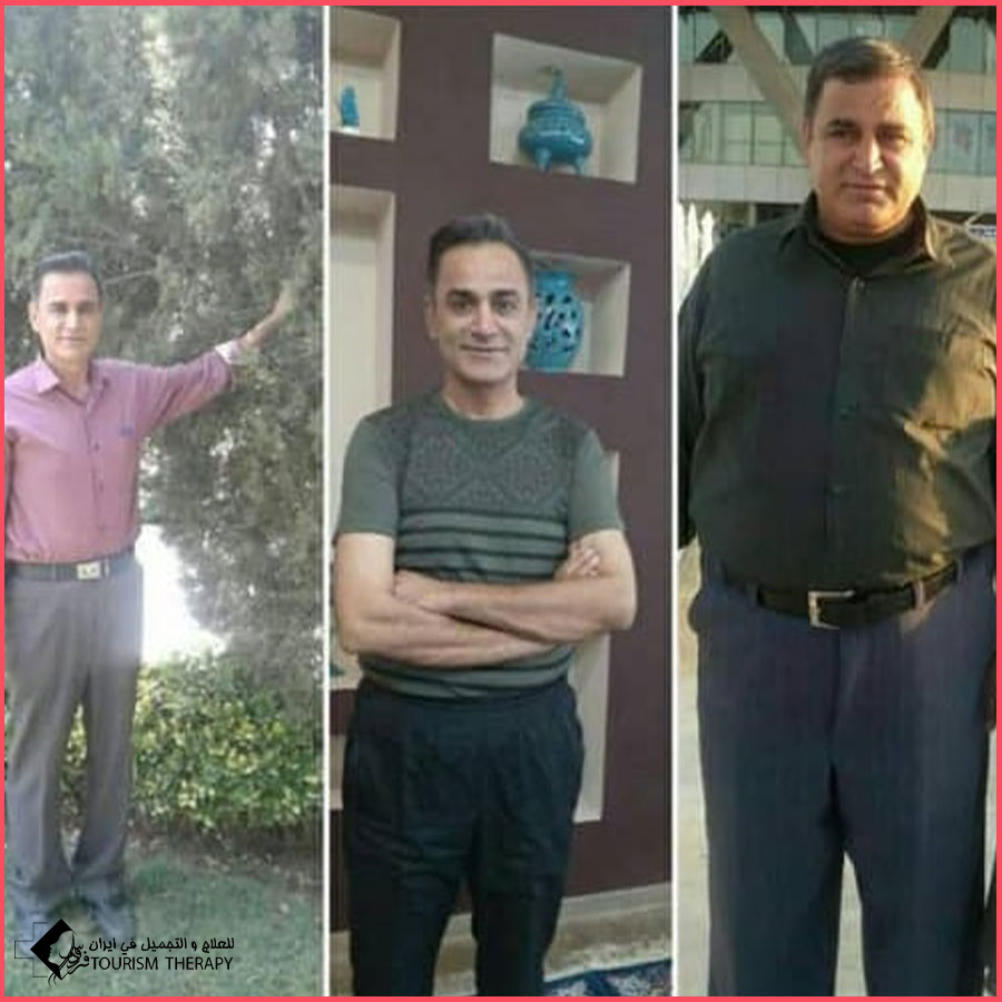 sasi dr amini syz ثنائي تقسيم المعدة في شيراز | الدكتور مسعود اميني