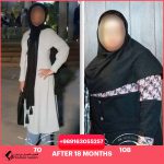 عملية ثنائي تقسيم المعدة في شيراز مع الدكتور بابك حسيني