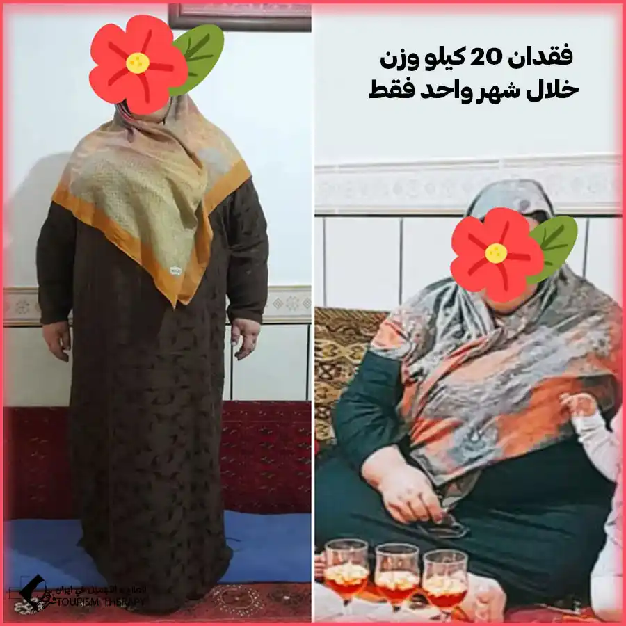 تكلفة عملية ثنائي تقسيم المعدة في مشهد مع الدكتور محمد ابراهيم كلانتري