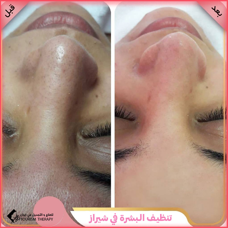 skincare Shiraz تنظيف البشرة في شيراز