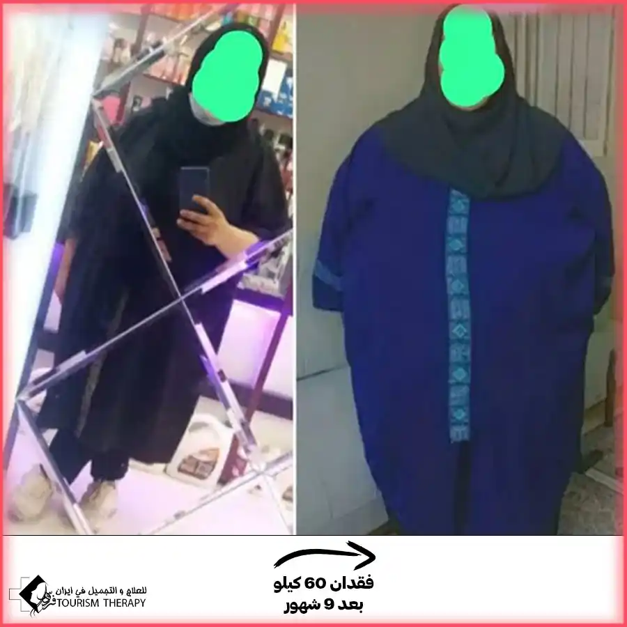عملية قص المعدة في مشهد مع الدكتور محمد ابراهيم كلانتري