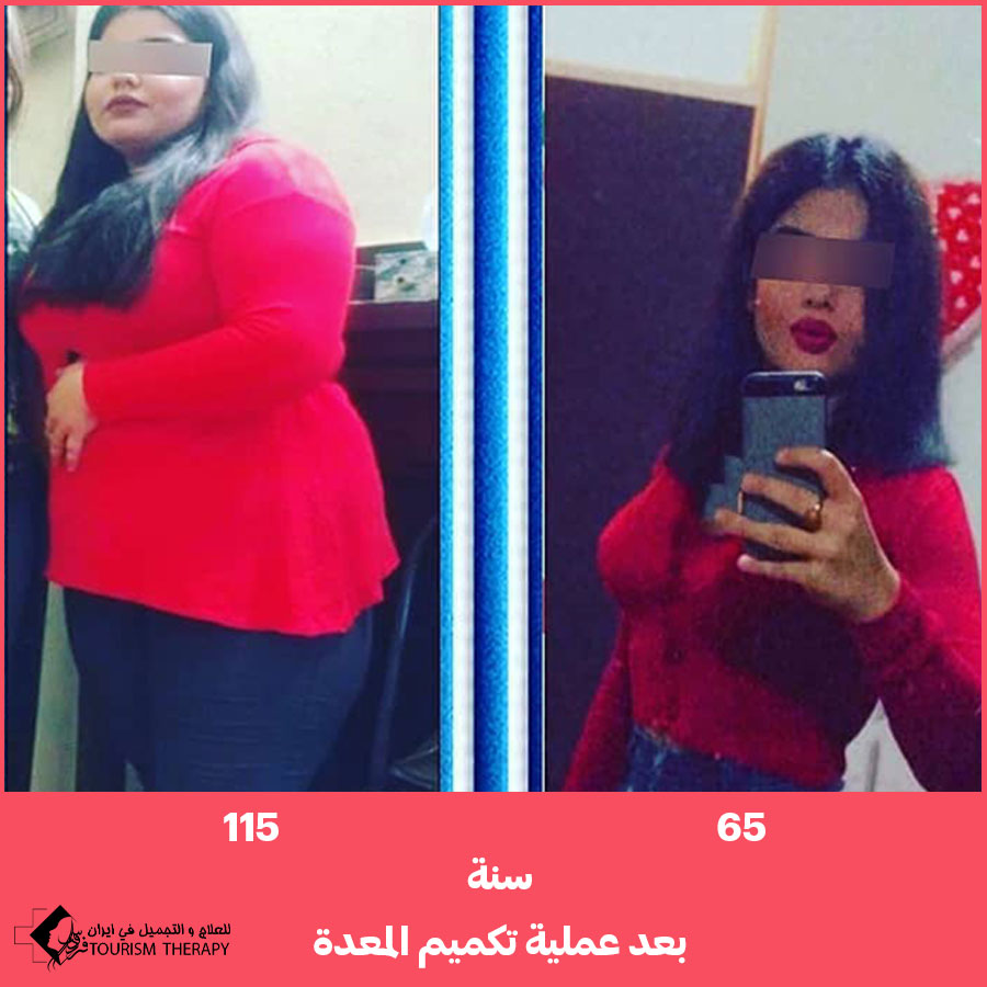 عملية قص المعدة في شيراز مع الدكتور بابك حسيني