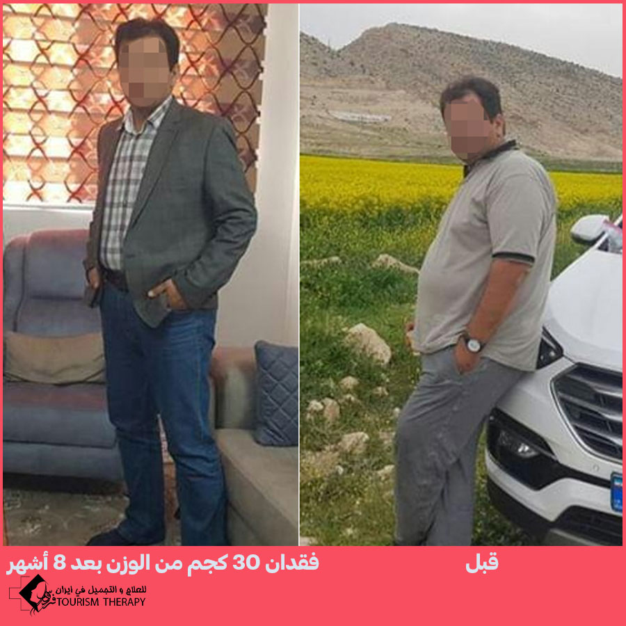 sleeve gastrectomy dr mahdi tahamtan syz قص المعدة في شيراز | الدكتور مهدي تهمتن