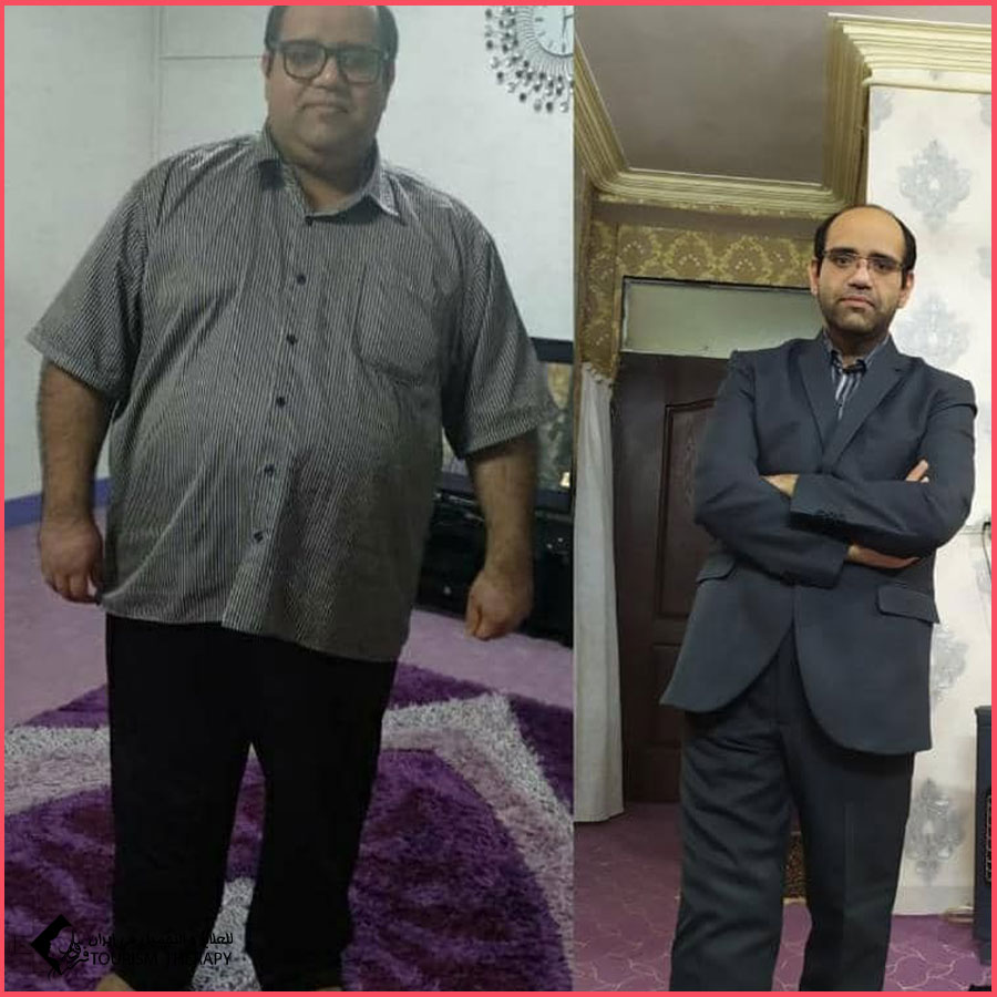 sleeve gastrectomy dr masoud amini syz قص المعدة في شيراز | الدكتور مسعود اميني